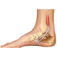 Sports Medicine Anchors