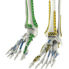 Ankle, Mid-foot & Forefoot Fracture Solutions