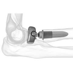 Align Radial Head System