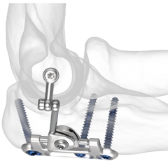 IJS Elbow (Internal Joint Stabilizer)
