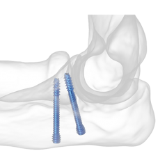 Reduct Headless Screws