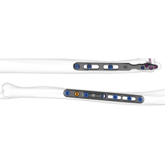FREEFIX Ulnar Shortening