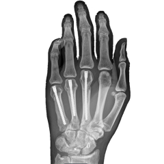 Hand Trauma Threaded Nails