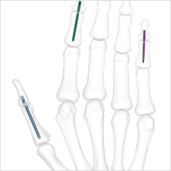 Reduct Arthrodesis DIP Screws