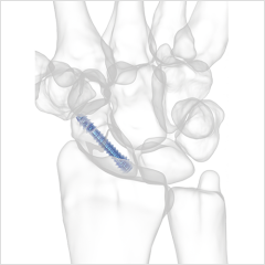 Reduct Headless Compression Screws