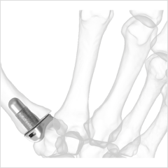 Stablyx CMC Arthroplasty