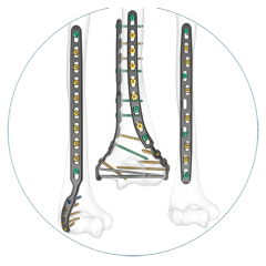 FREEFIX Distal & Midshaft Humeral Fixation System
