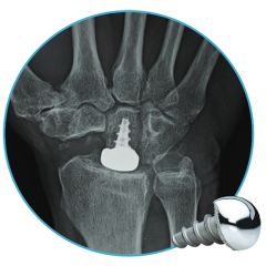 Wrist Motion Hemi Cap