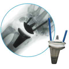 Wrist Motion Total Wrist