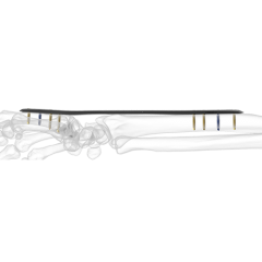 Dorsal Spanning Plate