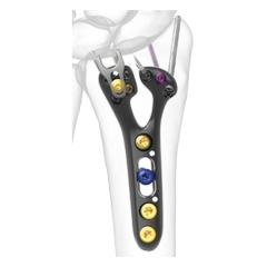 Geminus Distal Radius