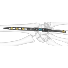 Implate Wrist Arthrodesis Nail