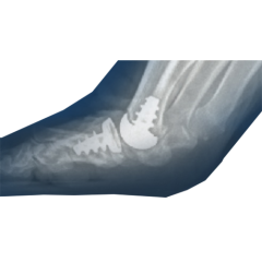 ToeMotion Hemi Cap & Total Toe