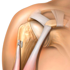 Distal Biceps & Tenodesis